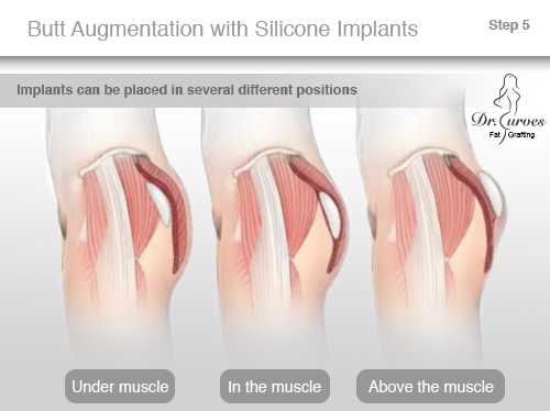 Silicone Butt Implant 35