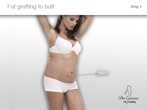 Fat grafting to butt
