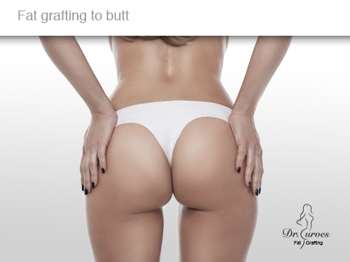Fat grafting to butt 3