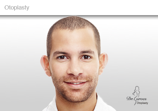 Otoplasty 3