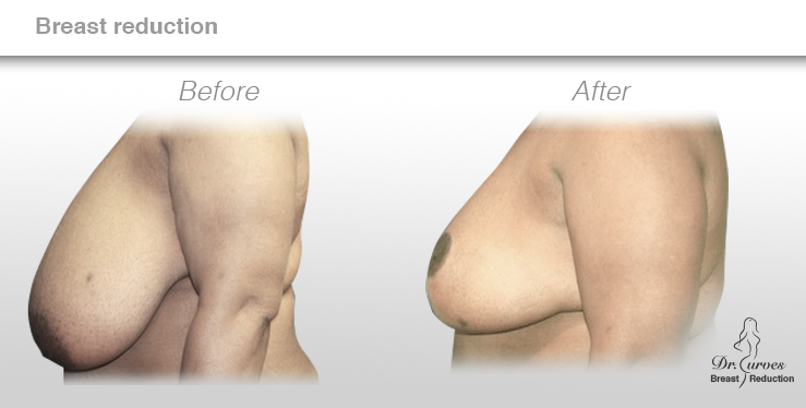 breast reduction 1