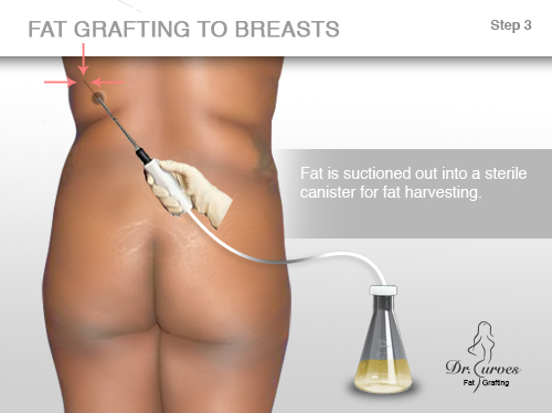 fat grafting to breasts 3