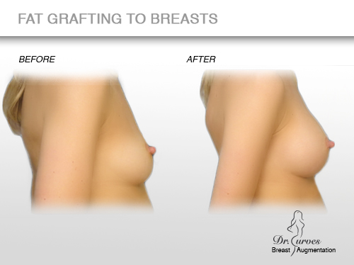 fat grafting to breasts 4