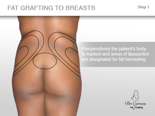 fat grafting to breasts
